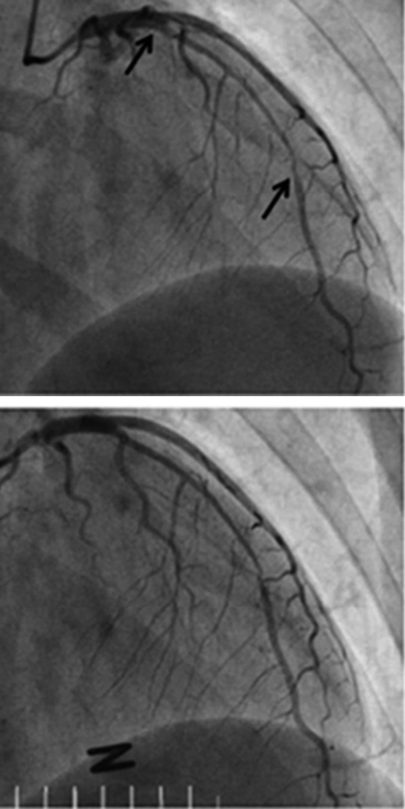 learn-the-signs-of-spontaneous-coronary-artery-dissection-heart-advisor