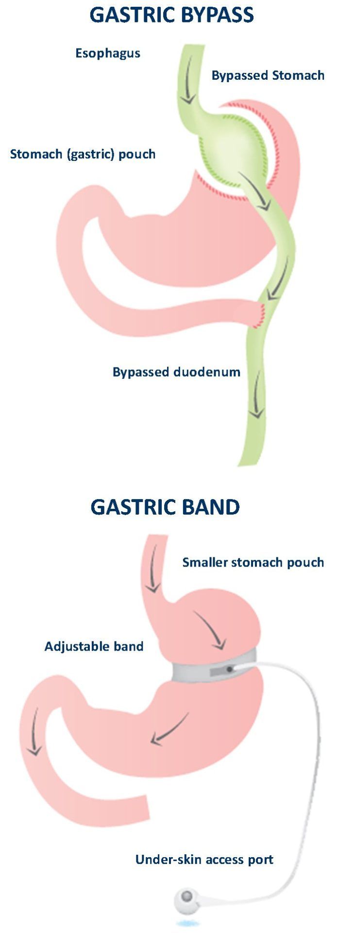 Research Shows Bariatric Surgery Provides LongTerm