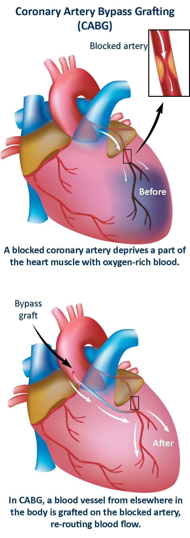 coronary-artery-bypass-surgery-in-women-heart-advisor