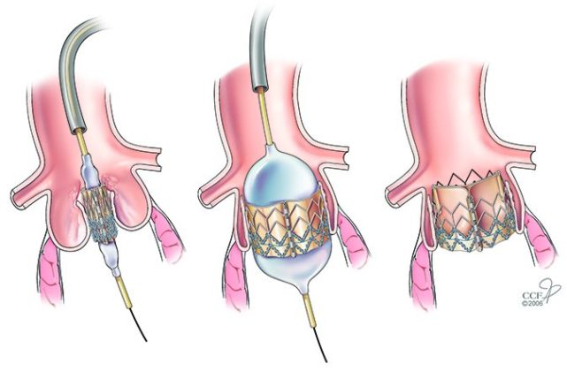 New TAVR Valves Available to More Patients, Safer Than